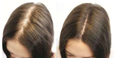 does biotin help for hair loss