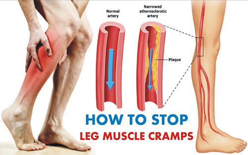 How to Stop Leg Cramps at Night